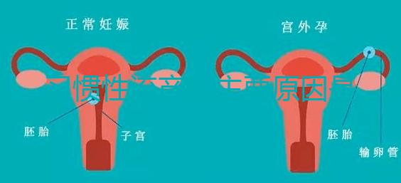 習(xí)慣性流產(chǎn)的主要原因是什么?